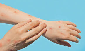 Registran caso de viruela símica en Tamaulipas 