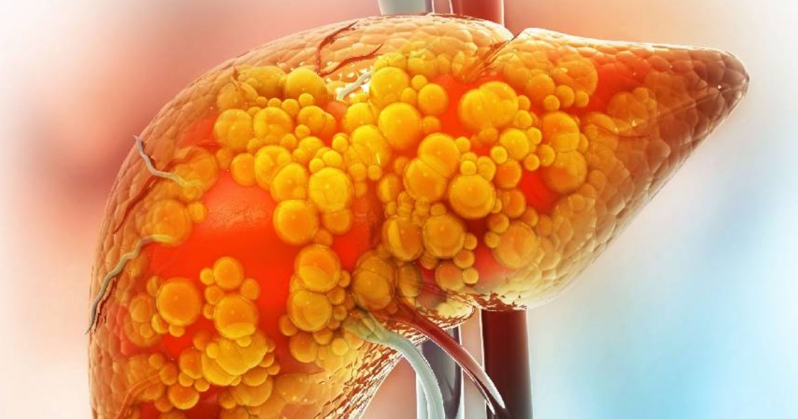 El hígado graso y los alimentos que pasan desapercibidos