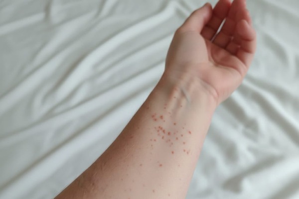 Tras confirmación de caso de sarampión, llaman a tomar medidas preventivas en Puebla