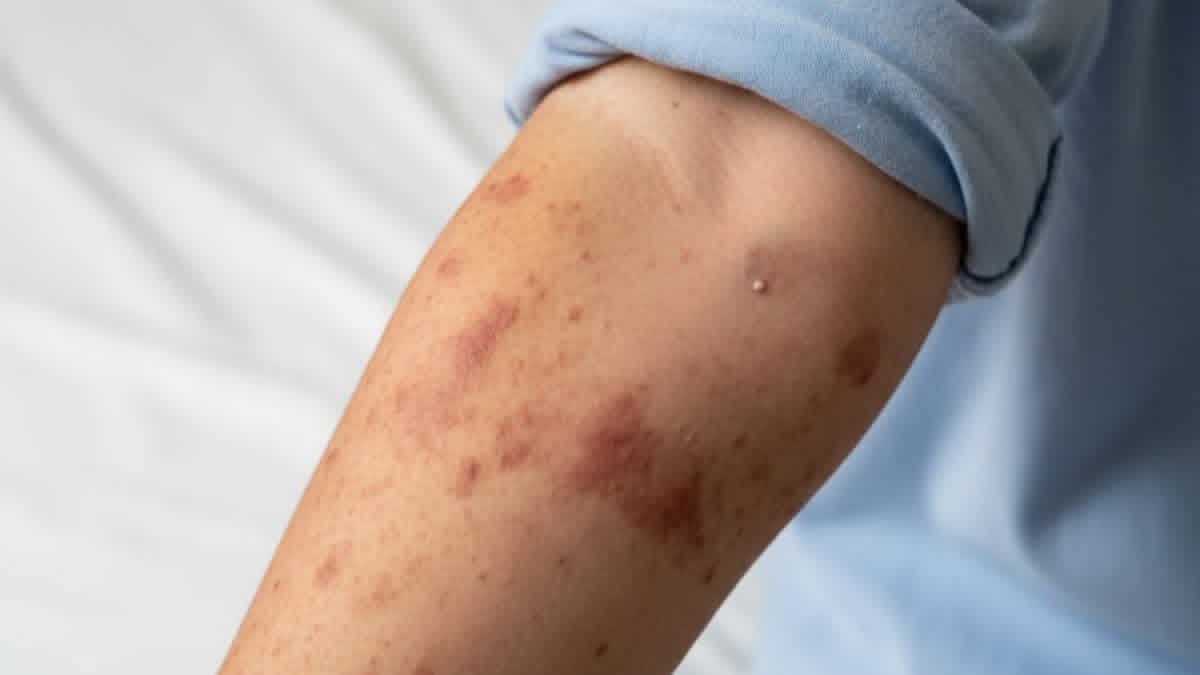 Confirman nuevo caso de Sarampión en Tlaxcala: la afectada, una bebé de Huamantla