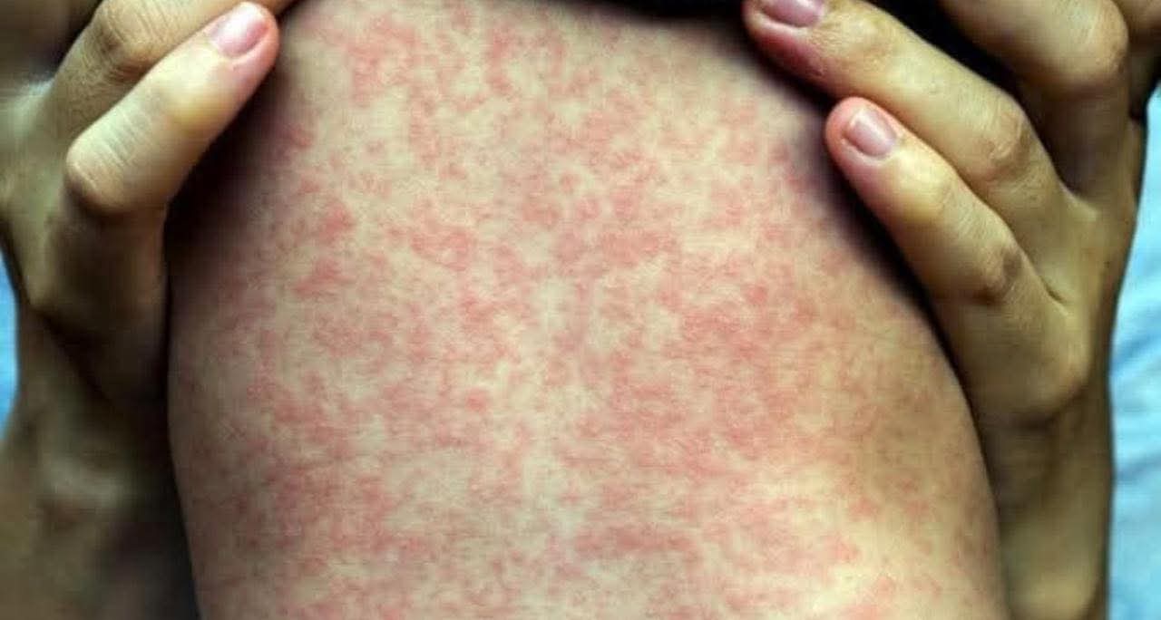 Alerta en Tlaxcala: sube a 9 los casos de sarampión y trasciende un deceso