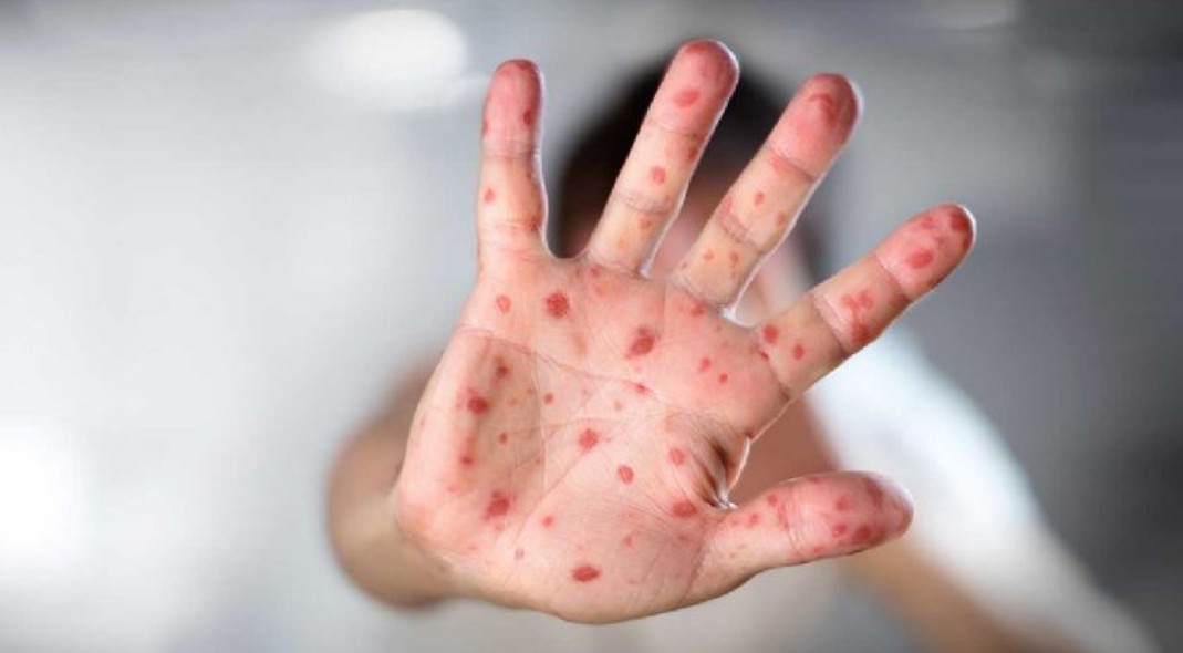 Qué es el sarampión y por qué representa un riesgo grave