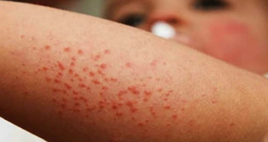 Siete estados concentran el 85% de los casos de sarampión en México