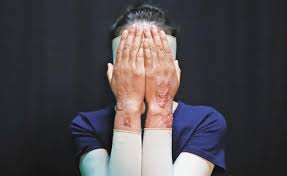 Confío en que todo el peso de la ley caerá sobre mi agresor: María Elena, saxofonista atacada con ácido