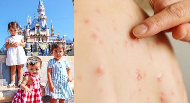 La otra epidemia: ya son 150 casos de sarampión en México