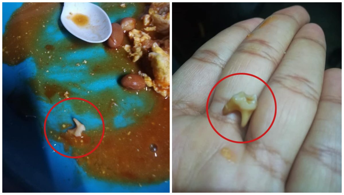 ¿Será una piedrita?: Mujer encuentra muela humana en una lata de frijoles