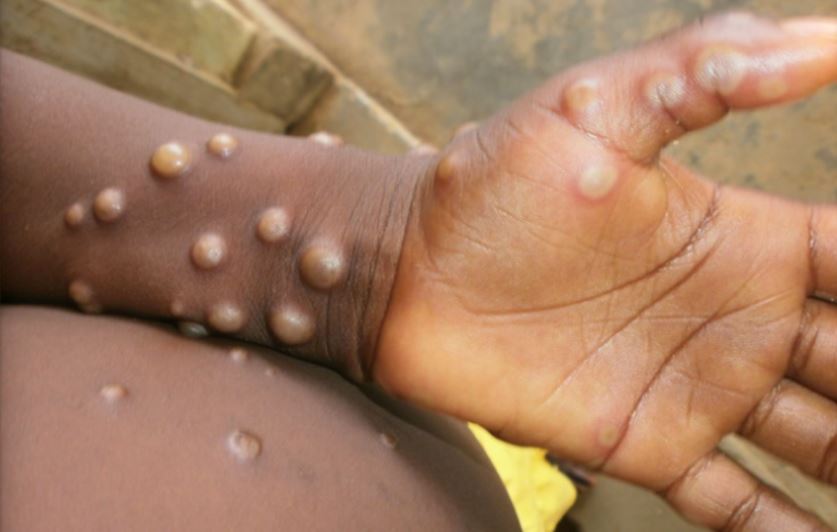 Hay 200 personas en observación tras contagiarse de viruela del mono 