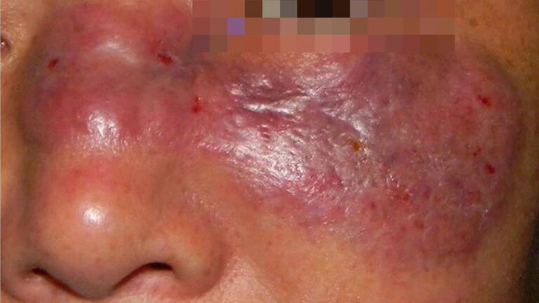 Se registra el primer caso post COVID-19 del hongo negro en México, la enfermedad que ha impactado a la India