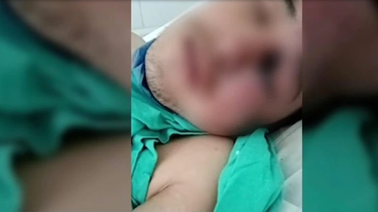 Familia de Gregorio, el paciente fallecido sospechoso de hongo negro, denunció que tardaron varios días para operarlo