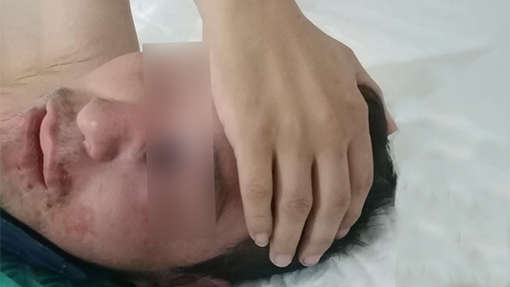 En Oaxaca, mujer que se contagió de 'hongo negro' se encuentra grave en el hospital