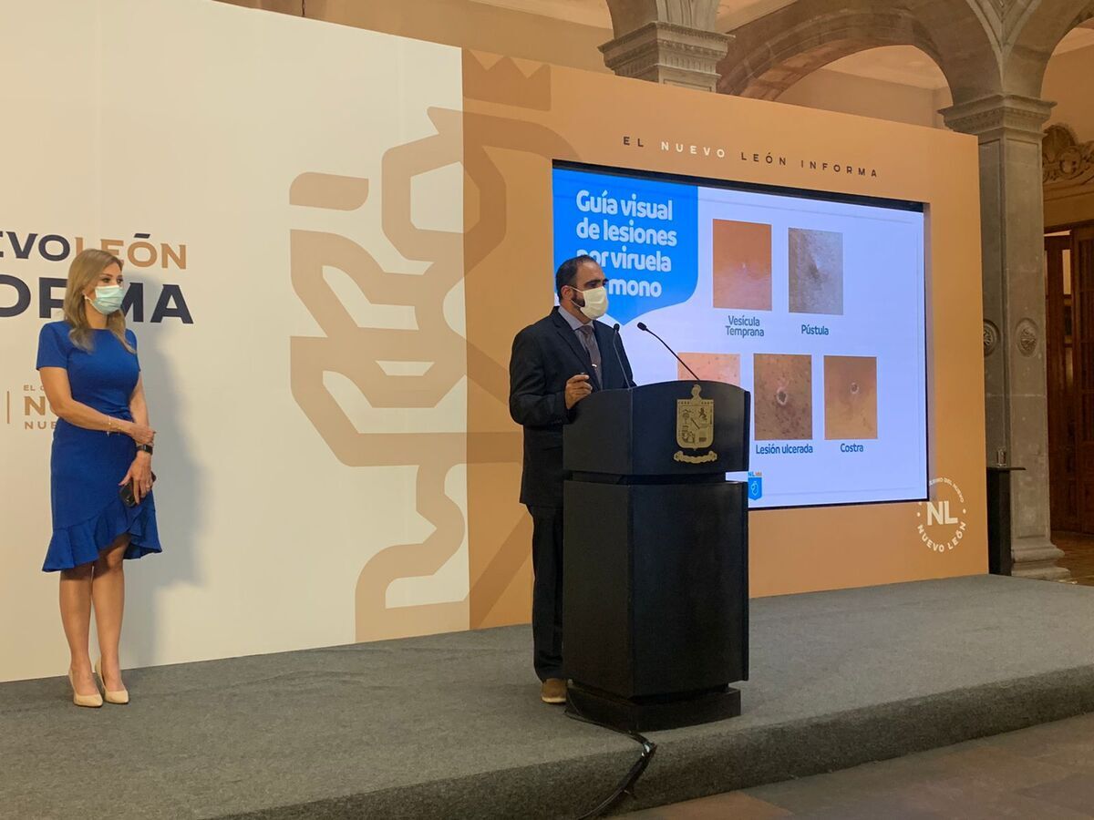 Confirman otro caso de viruela símica en NL, siendo el cuarto estado en el país con más casos 