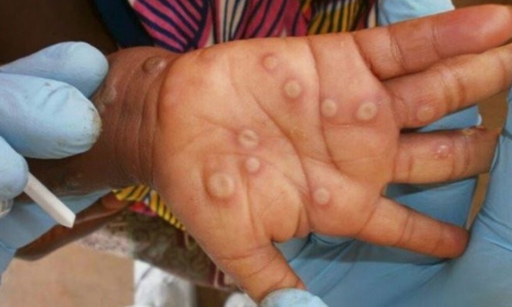 Irán reporta su primer caso de viruela símica