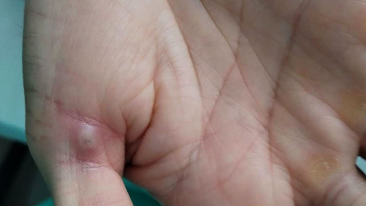 Confirma Aguascalientes su primer caso de viruela símica 