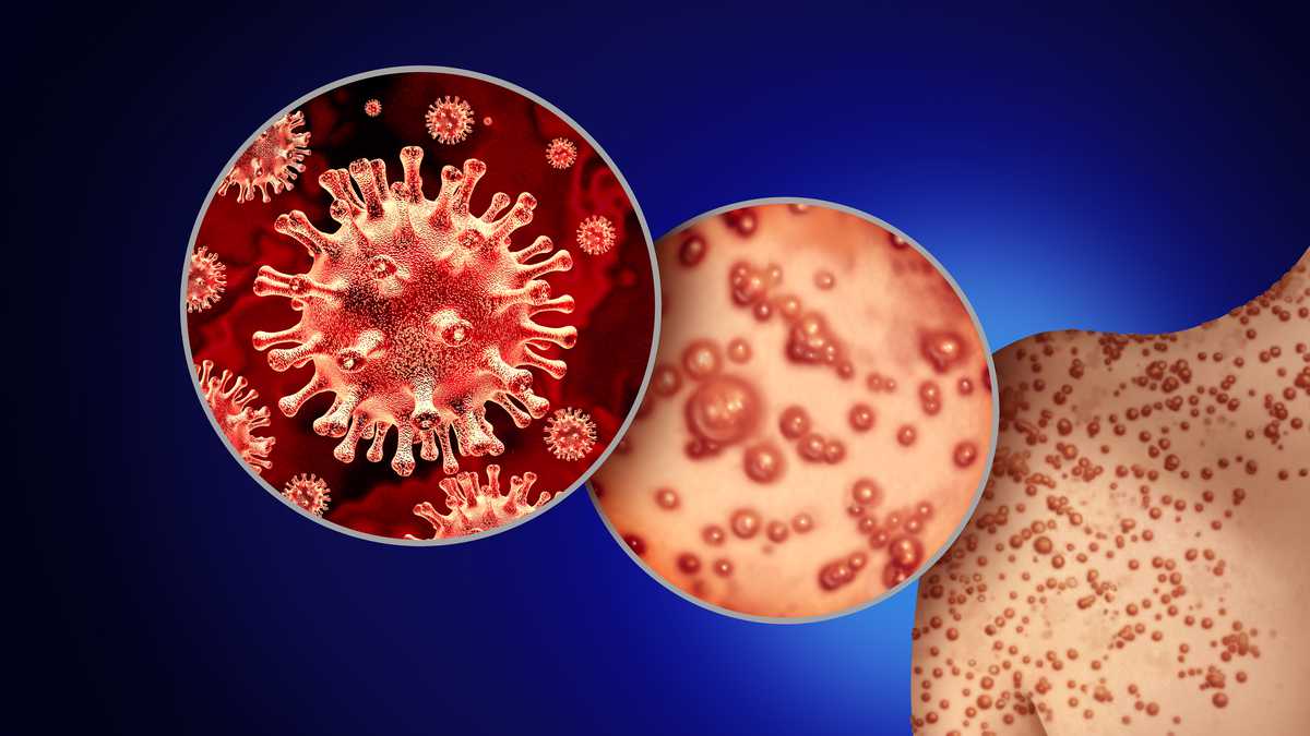 Casos de viruela símica van en descenso a nivel mundial, pero aumentan en América