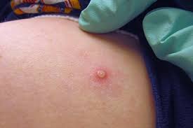 Casos de viruela símica en México se duplican en una semana