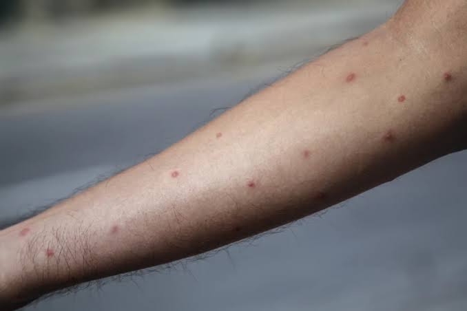 Confirma Gatell segundo caso en la CDMX de viruela del mono