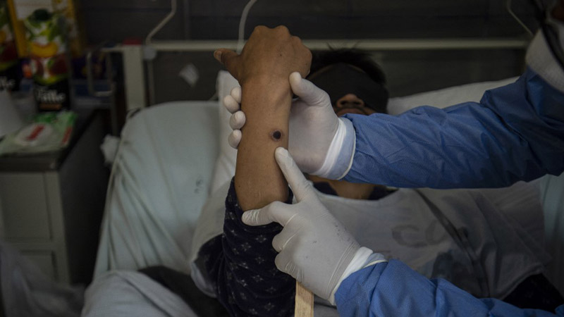 México ha registrado 4 muertes por viruela del mono hasta ahora; van más de 3 mil contagios
