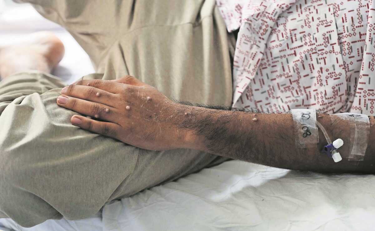 Nayarit emite alerta por 20 casos de viruela símica