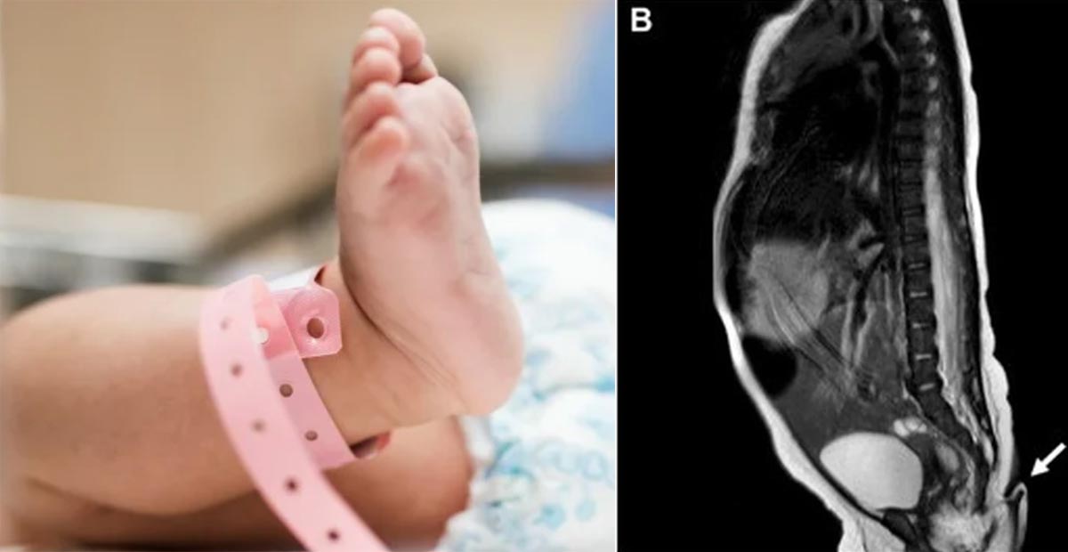 Nace bebé con cola de casi 6 centímetros de largo en Nuevo León