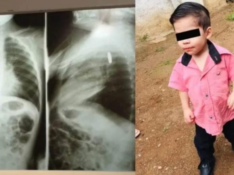 Niño de 2 años se traga una pila y sufre lesiones internas; familia pide ayuda para su tratamiento