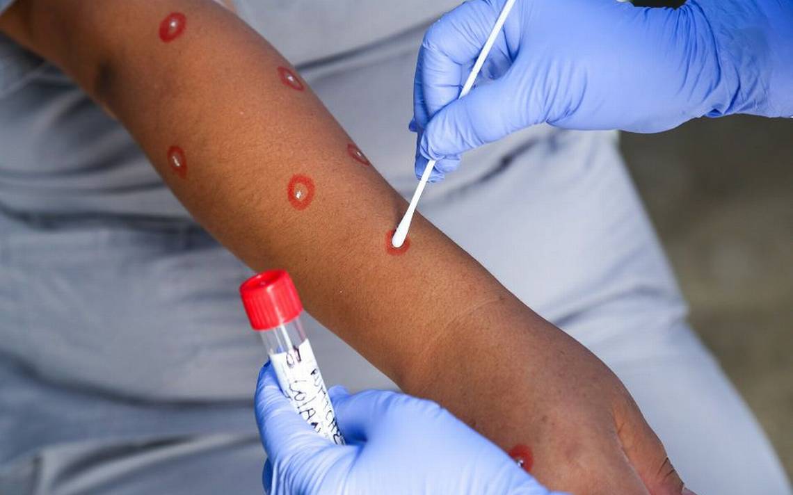 Jalisco suma 156 casos de viruela símica, recientemente registró 29 casos nuevos