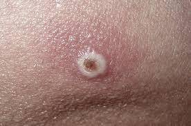 Casos de viruela símica en Morelos pasan de 4 a 6 confirma salud del estado