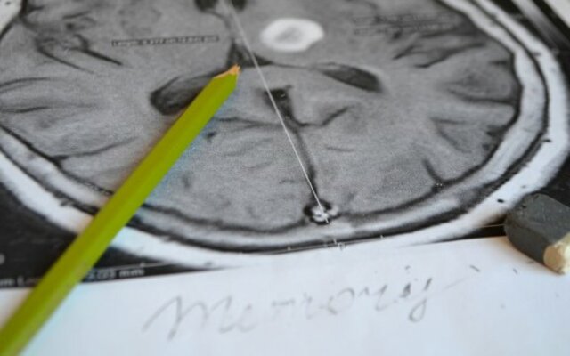 Amnesia: síntomas y prevención