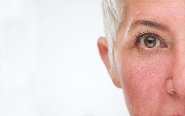 La rosácea, mucho más que un rubor