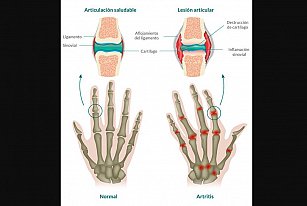 Artritis reumatoide en México: diagnóstico temprano mejora calidad de vida