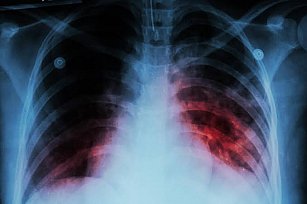 Detectan caso de tuberculosis en Tlaxcala: Autoridades descartan riesgo