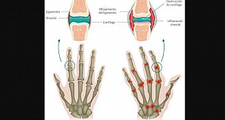 Artritis reumatoide en México: diagnóstico temprano mejora calidad de vida