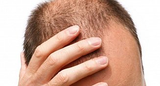 ¿Cuándo es preocupante la caída del cabello en los hombres?