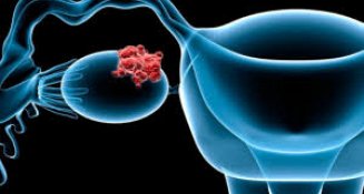Cáncer de ovario: detectarlo a tiempo puede salvar tu vida