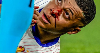 Kylian Mbappé sufre fractura de la nariz 