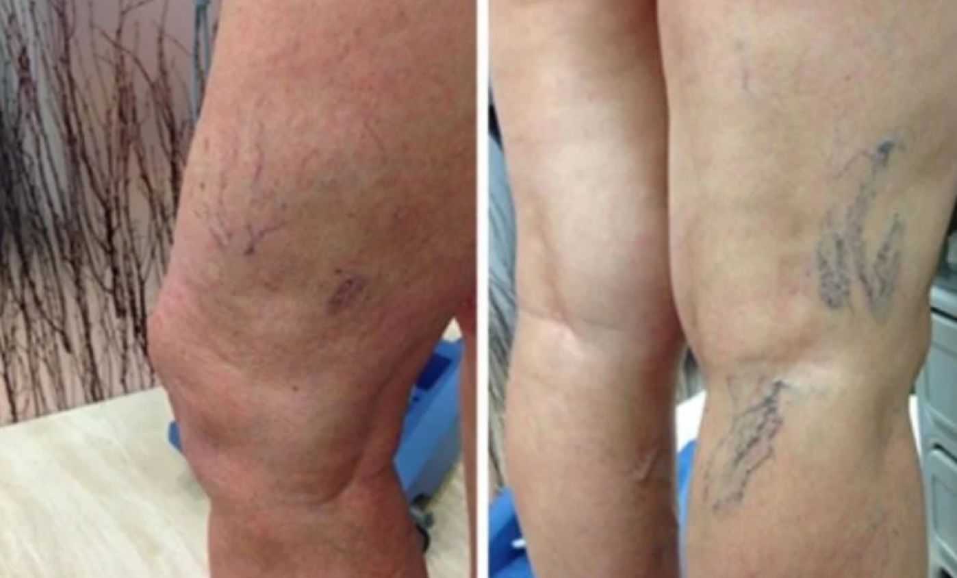 Varices y arañitas: más que un problema estético