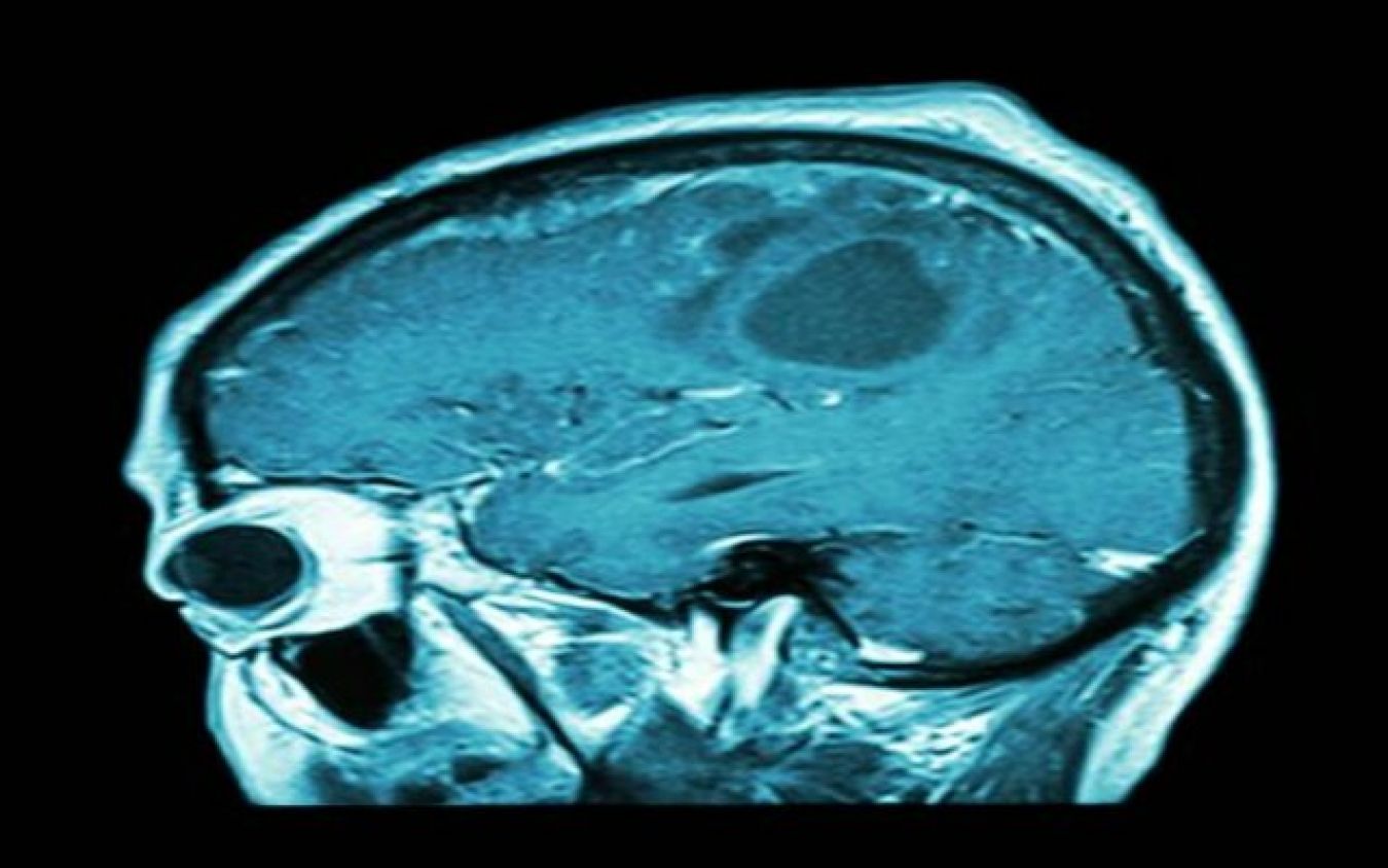 ¿Pronto una vacuna contra el cáncer cerebral?