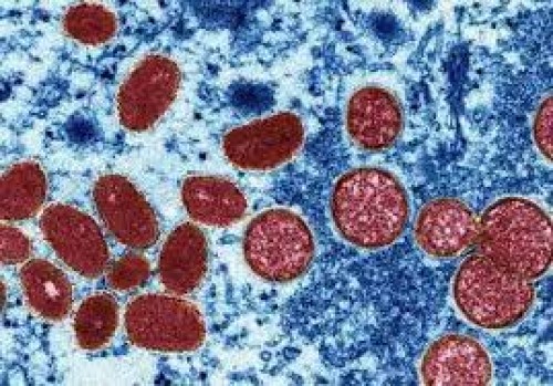 Europa refuerza controles tras primer caso de mpox en Suecia