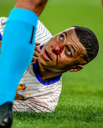 Kylian Mbappé sufre fractura de la nariz 