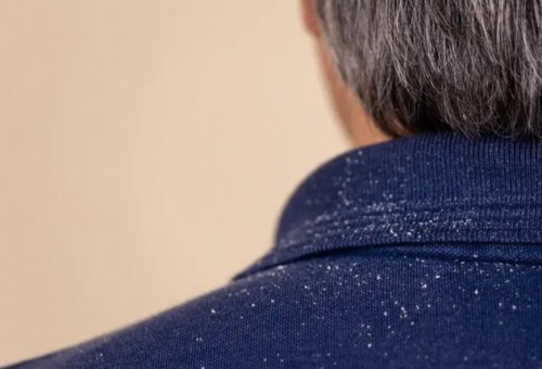 El invierno y la caspa: una relación más común de lo que crees