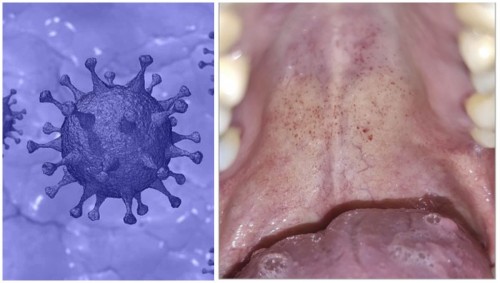 Estudio muestra que los enantemas bucales podrían ser un nuevo síntoma de COVID-19