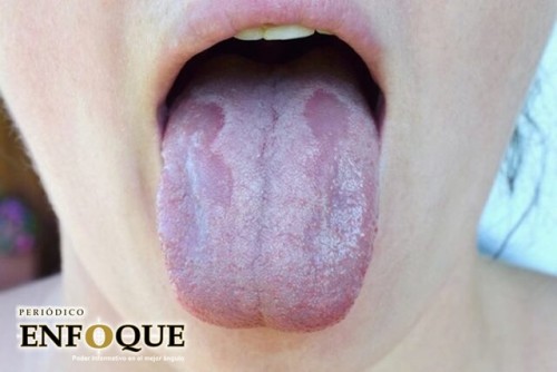 Lengua Covid: El nuevo síntoma que podría alertar de una infección de coronavirus 