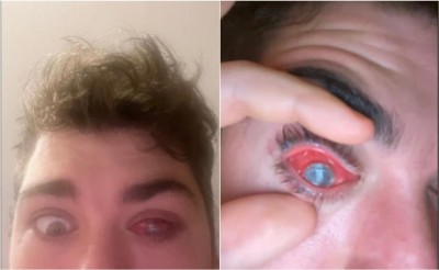 Joven olvida quitarse lentes de contacto para dormir y casi pierde un ojo; incidente se hace viral (Vídeo)