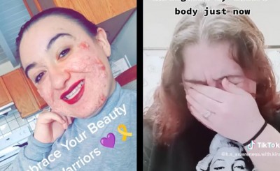 “Me dicen Freddy Krueger”:  Mujer con enfermedad de la piel denuncia que le hacen bullying (Vídeo)