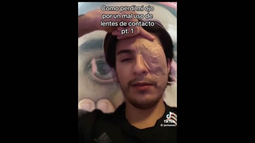 Joven relata cómo fue que perdió un ojo por usar lentes de contacto (Vídeo)