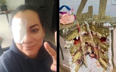 Mujer estuvo a punto de perder un ojo tras ser empujada a su pastel de cumpleaños (Vídeo)